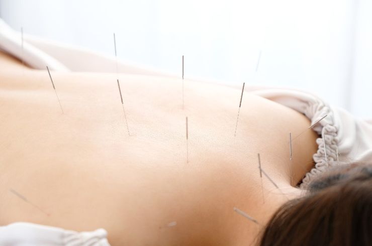 自費治療　鍼治療　部分治療(例：肩・腰)