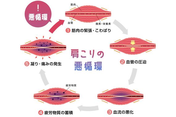 肩こりを放っておくと出やすい症状