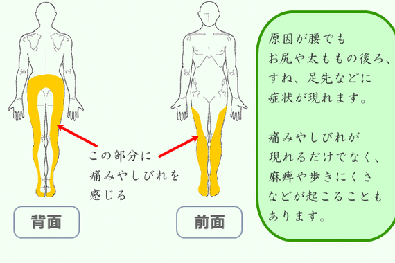 坐骨神経痛